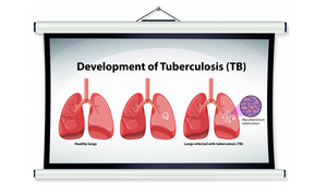 Tuberculosis Awareness Day